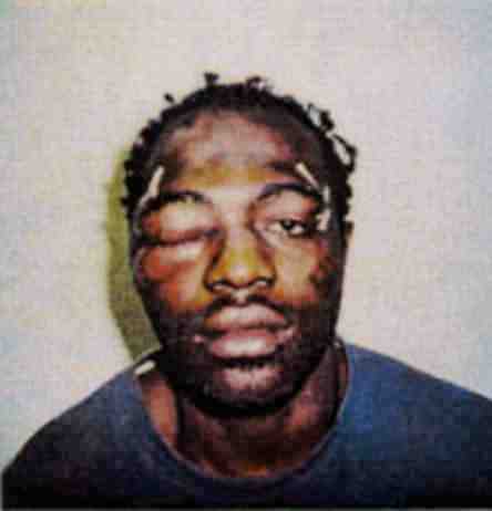 Rodney King after brutal beating by LAPD cops, which led to a widespread rebellion by the Black community.