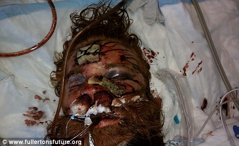 Kelly Thomas died from his injuries after Fullerton, CA police tasered and beat him.