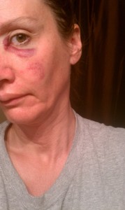 Police file photo of some of Schlenkerman victim's injuries after he beat her in face with his belt.