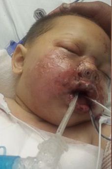 Bounkham Phonesavanh, 19 months, after being struck by a stun grenade thrown by Georgia SWAT team members. He is shown in a medically induced coma. His photo is at top of story with other child victims of police,